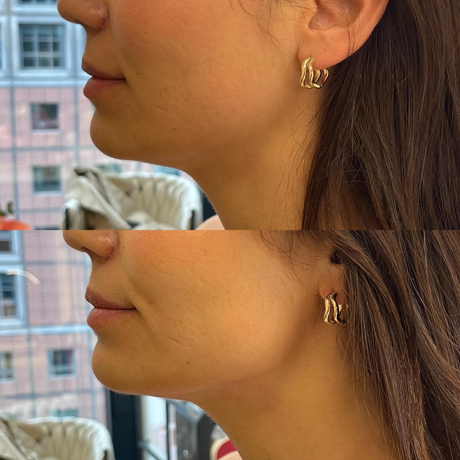 Bodyshaping – definierte Jawline und Konturen