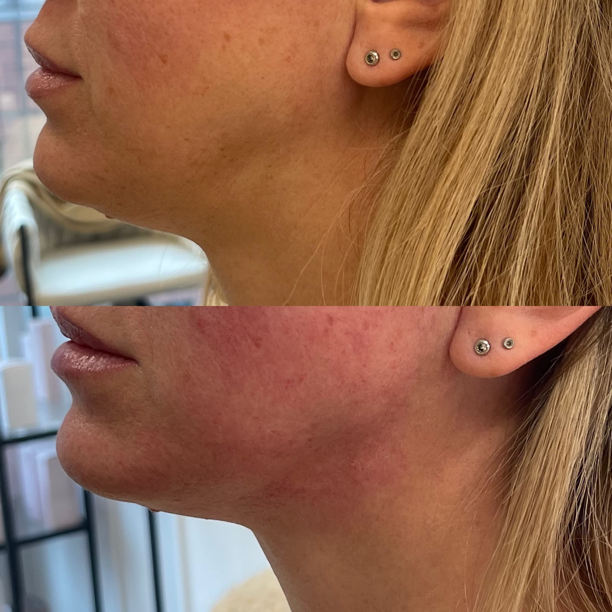 Gesichtskonturierung — Vorher/Nachher