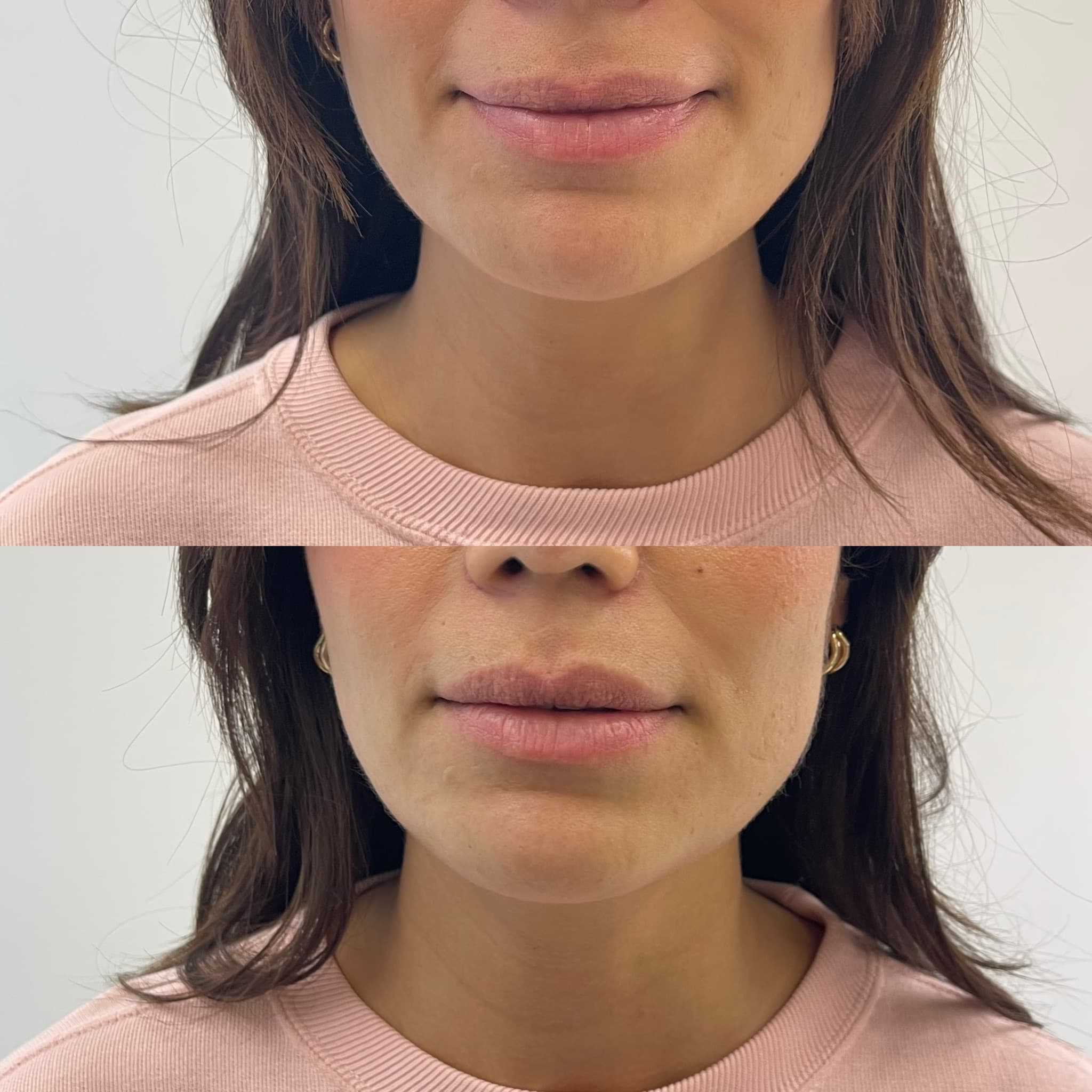 Body Shaper Jawline Contouring — Vorher/Nachher