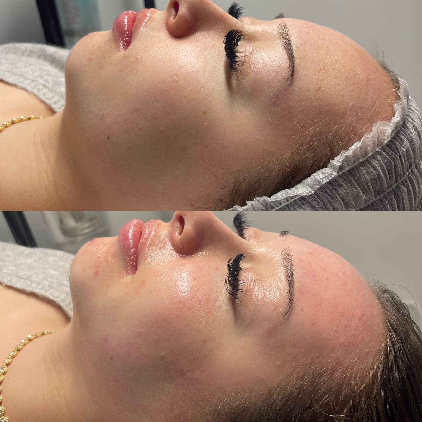 Microneedling 1