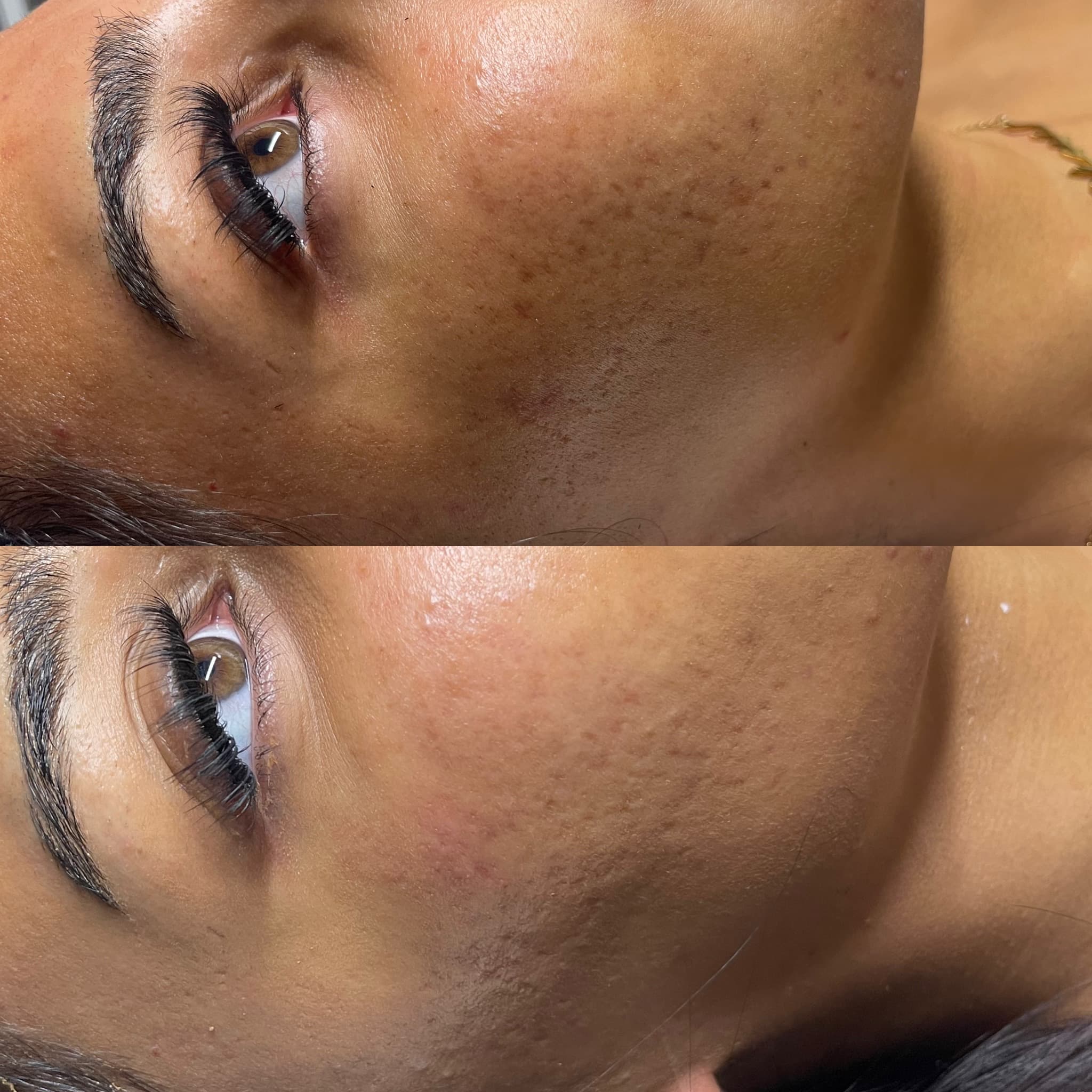 Microneedling 3