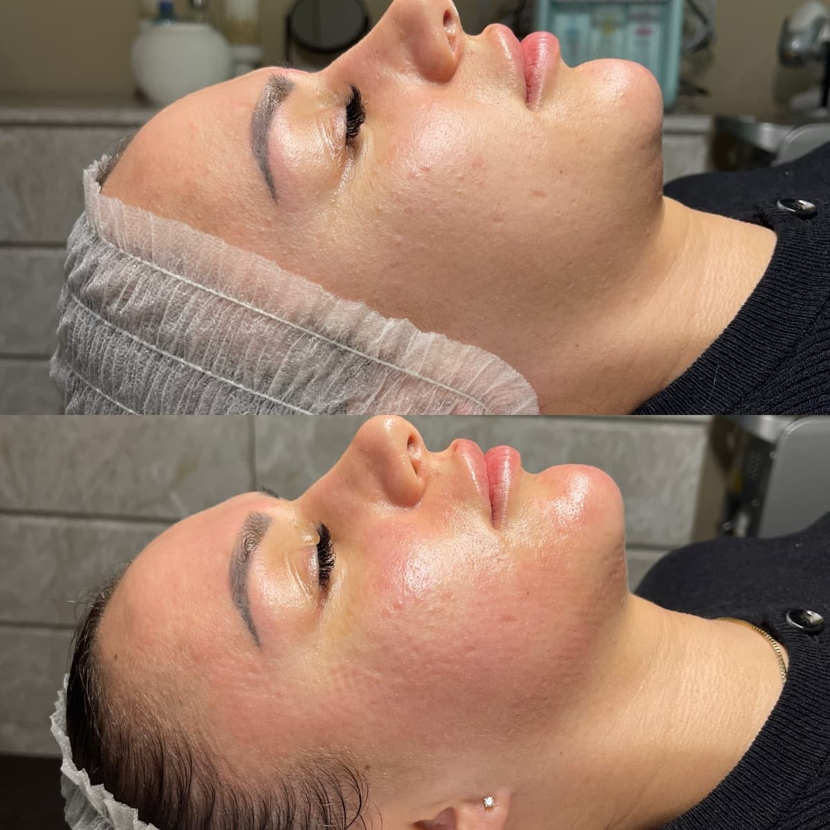 RF Crystal Microneedling — Hautverfeinerung — Vorher/Nachher
