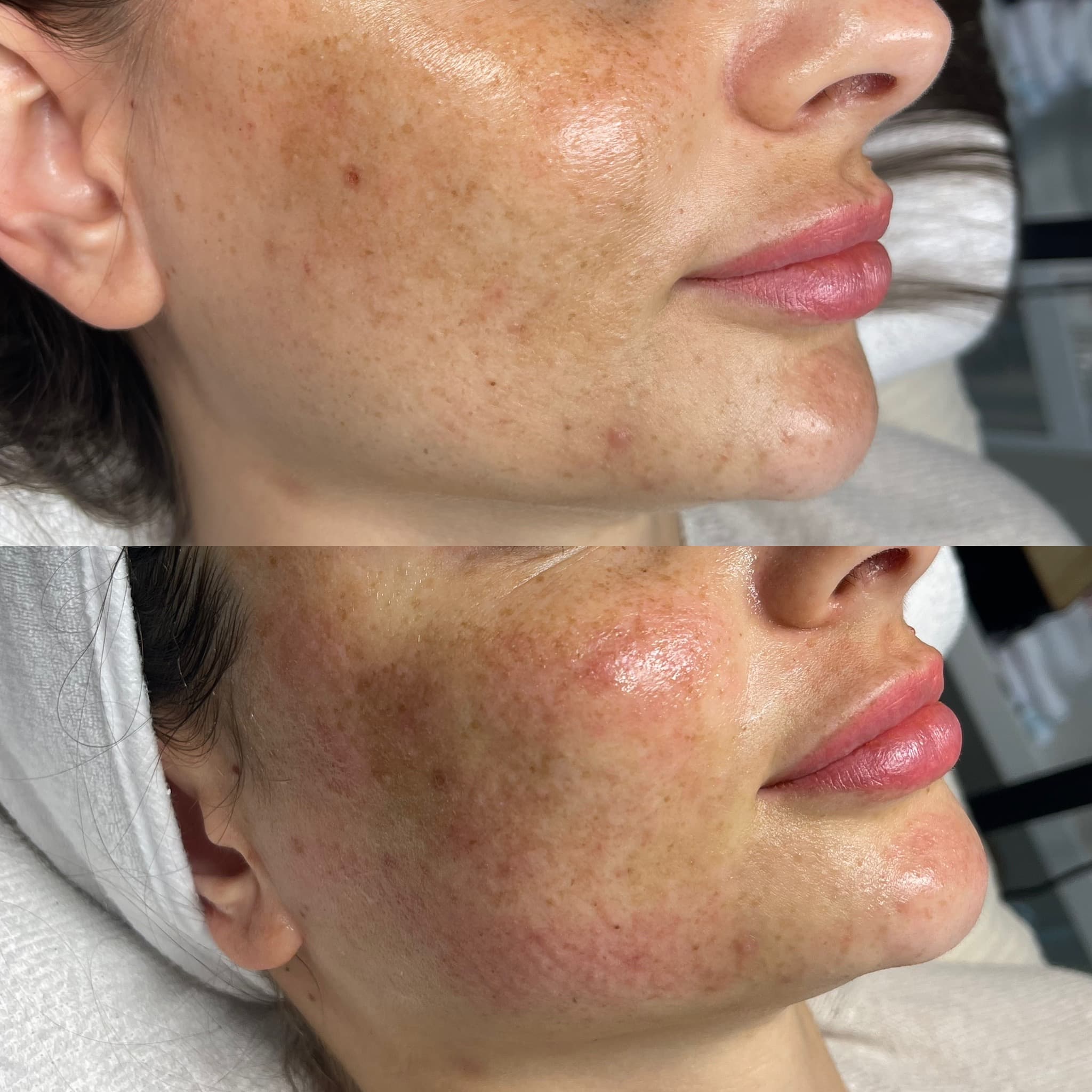 RF Microneedling 2