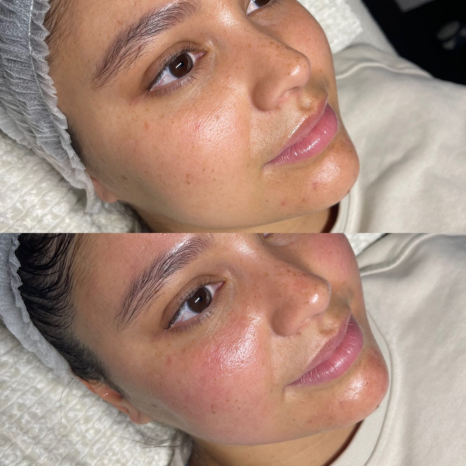 RF Microneedling 3