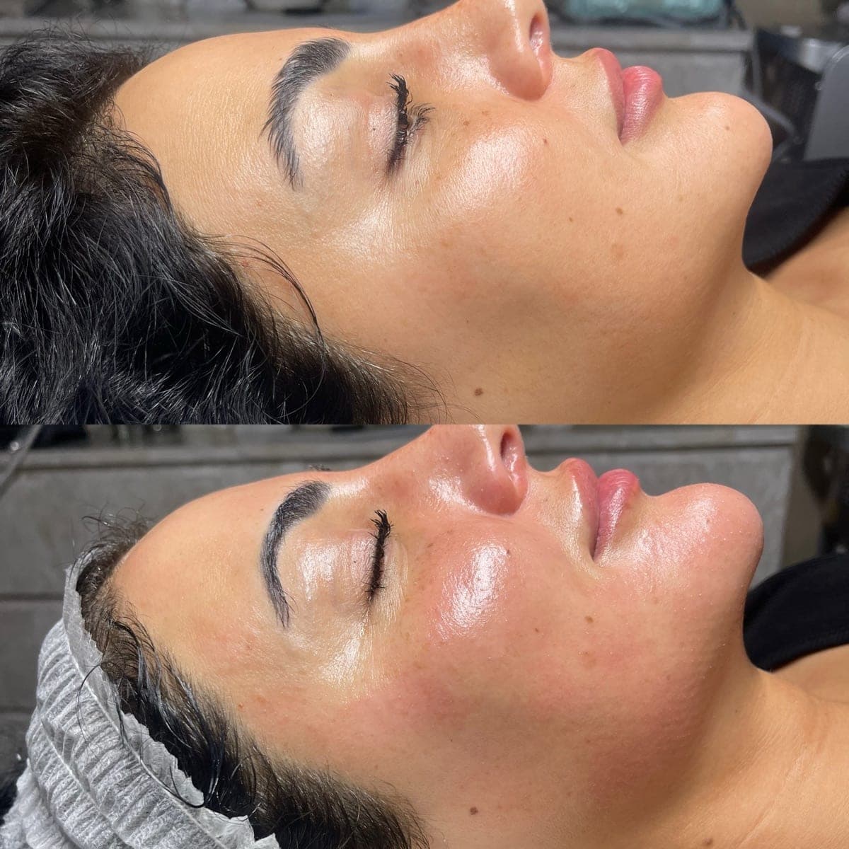 RF Microneedling 4