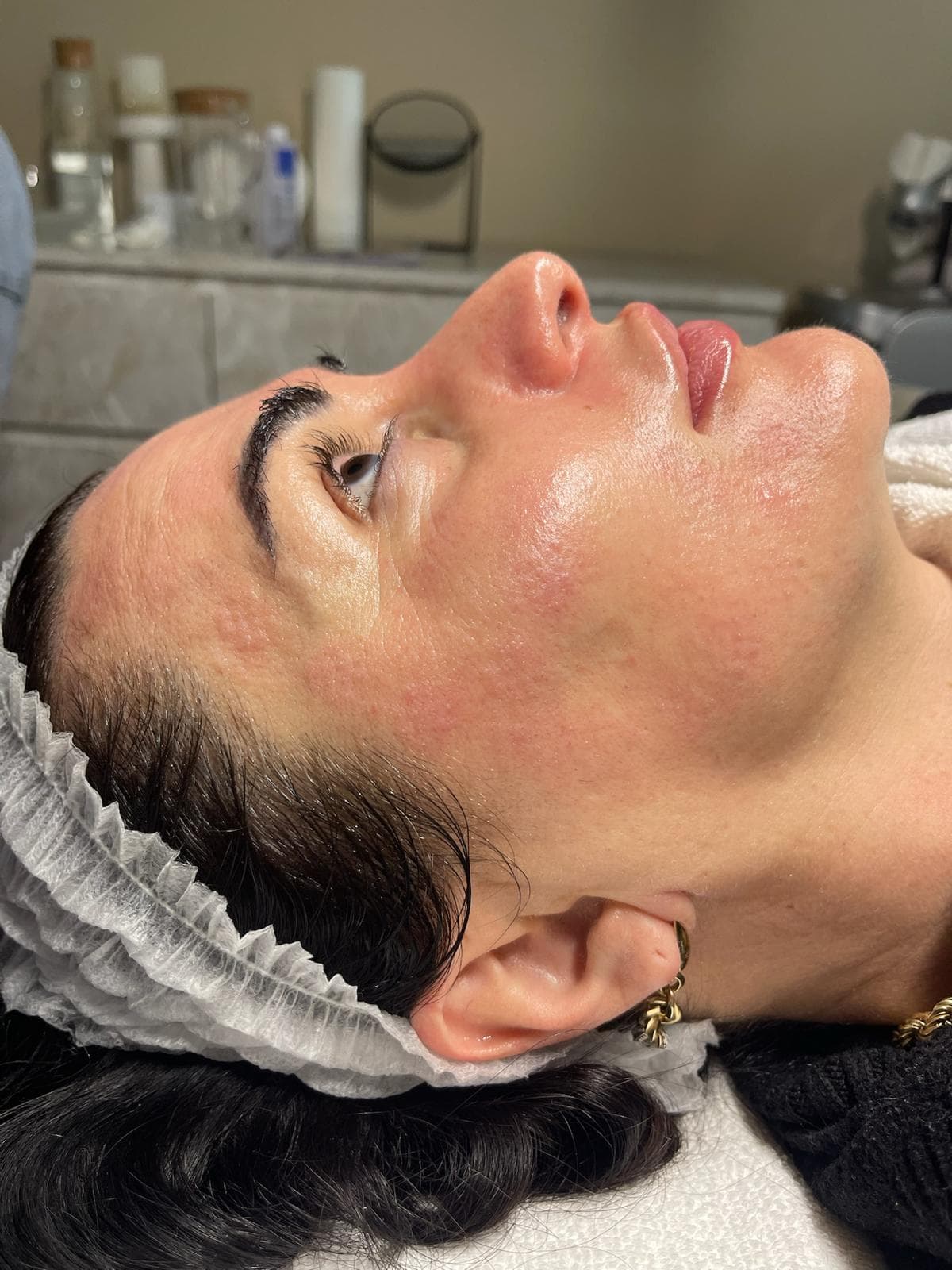 Microneedling 6