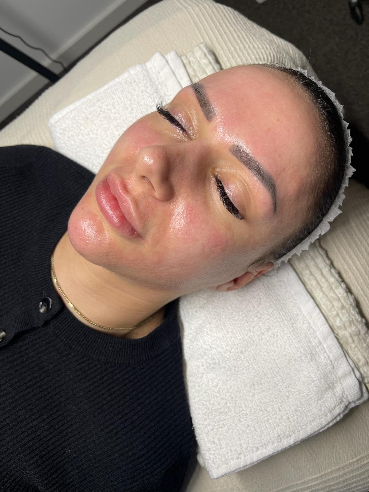 Microneedling 7