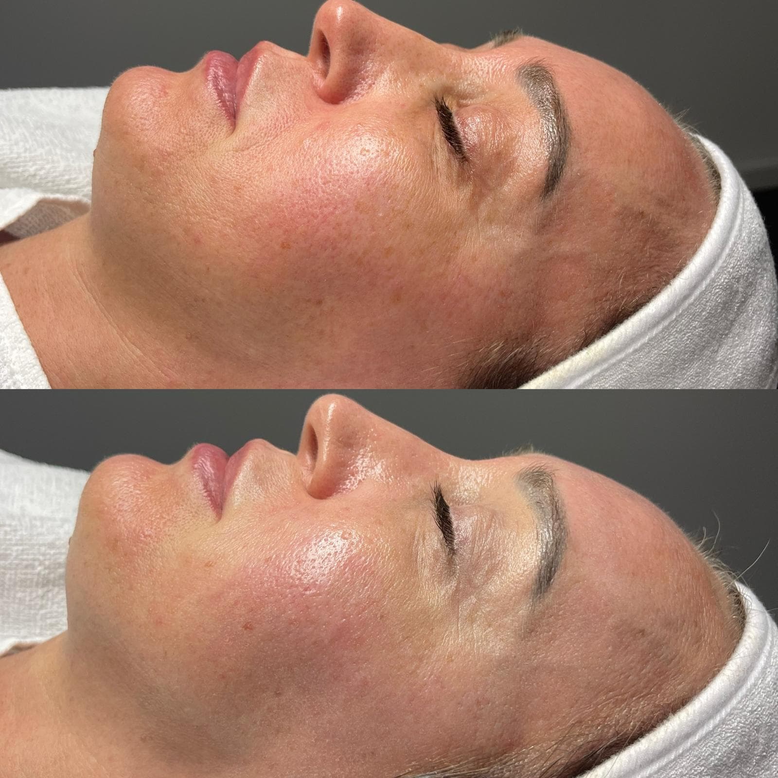 Microneedling 8