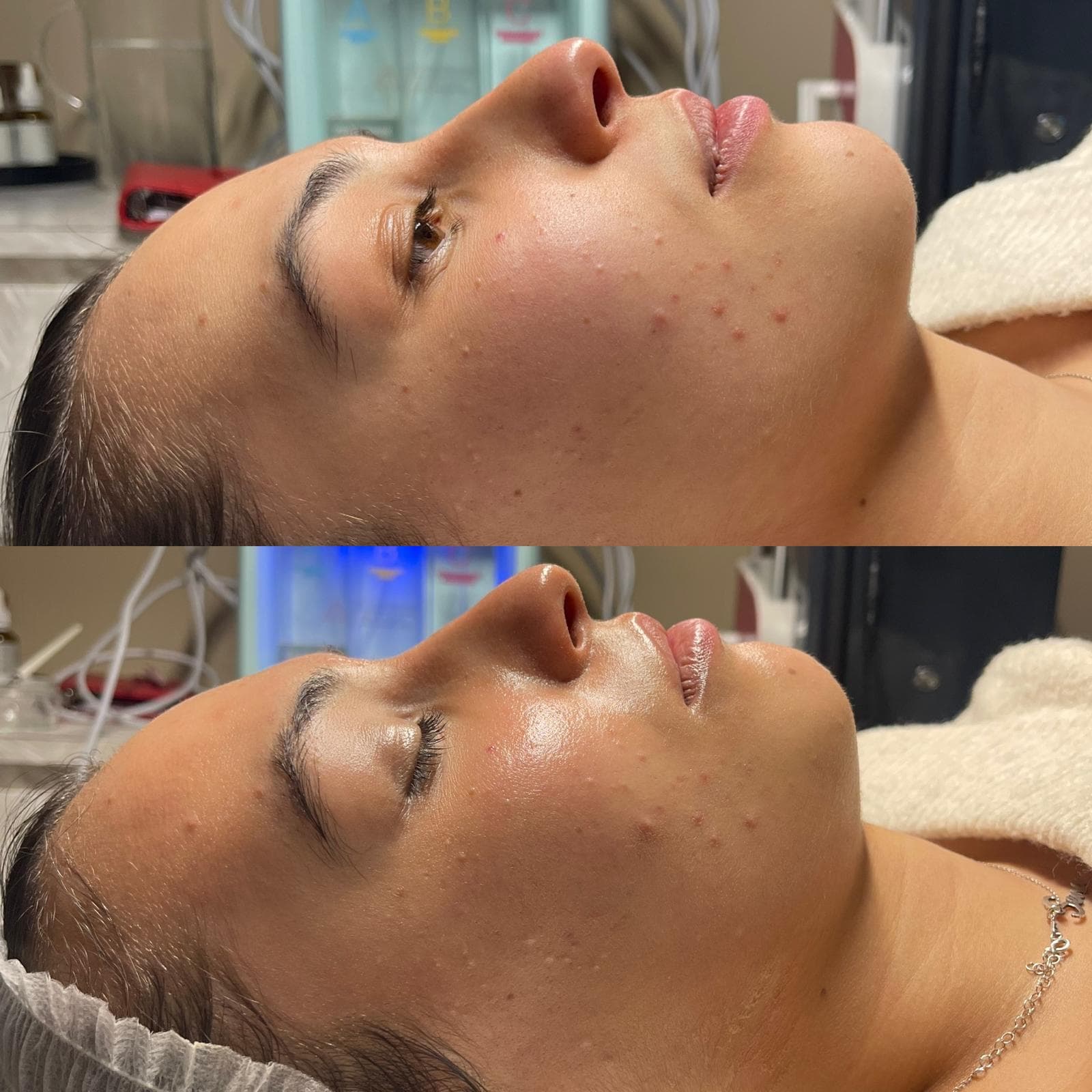 Microneedling 9