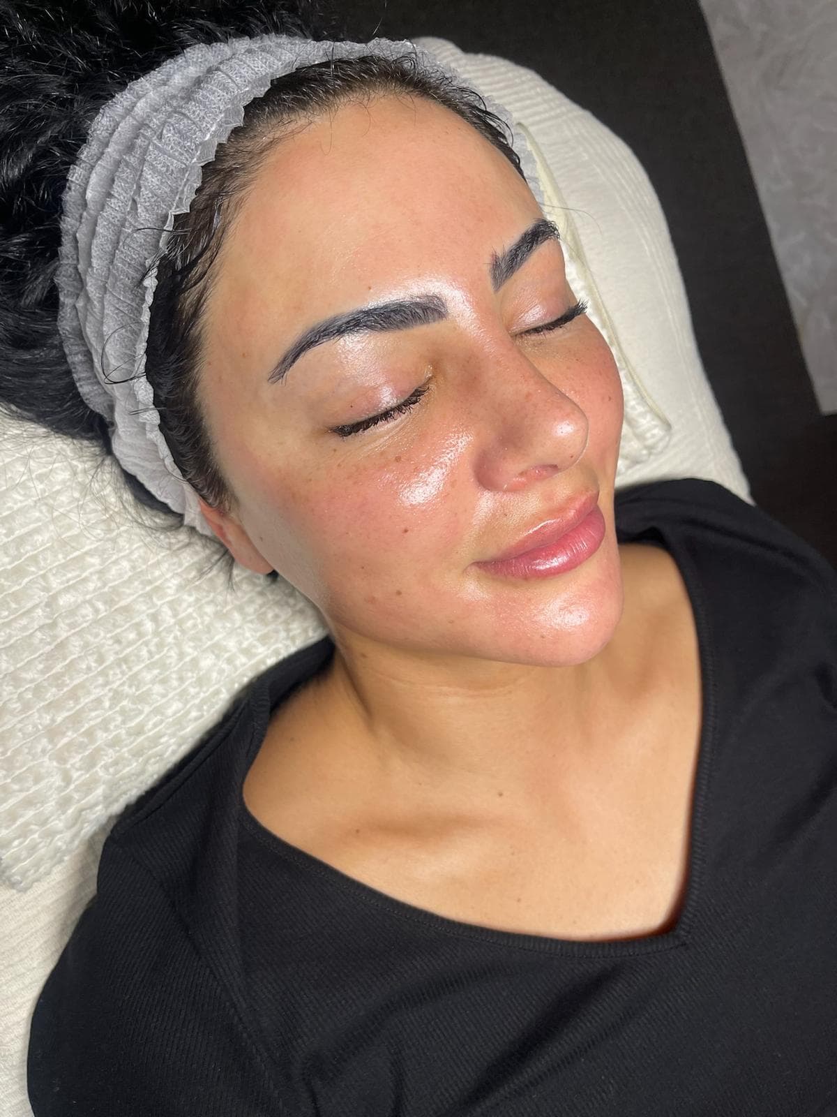 RF Crystal Microneedling 5
