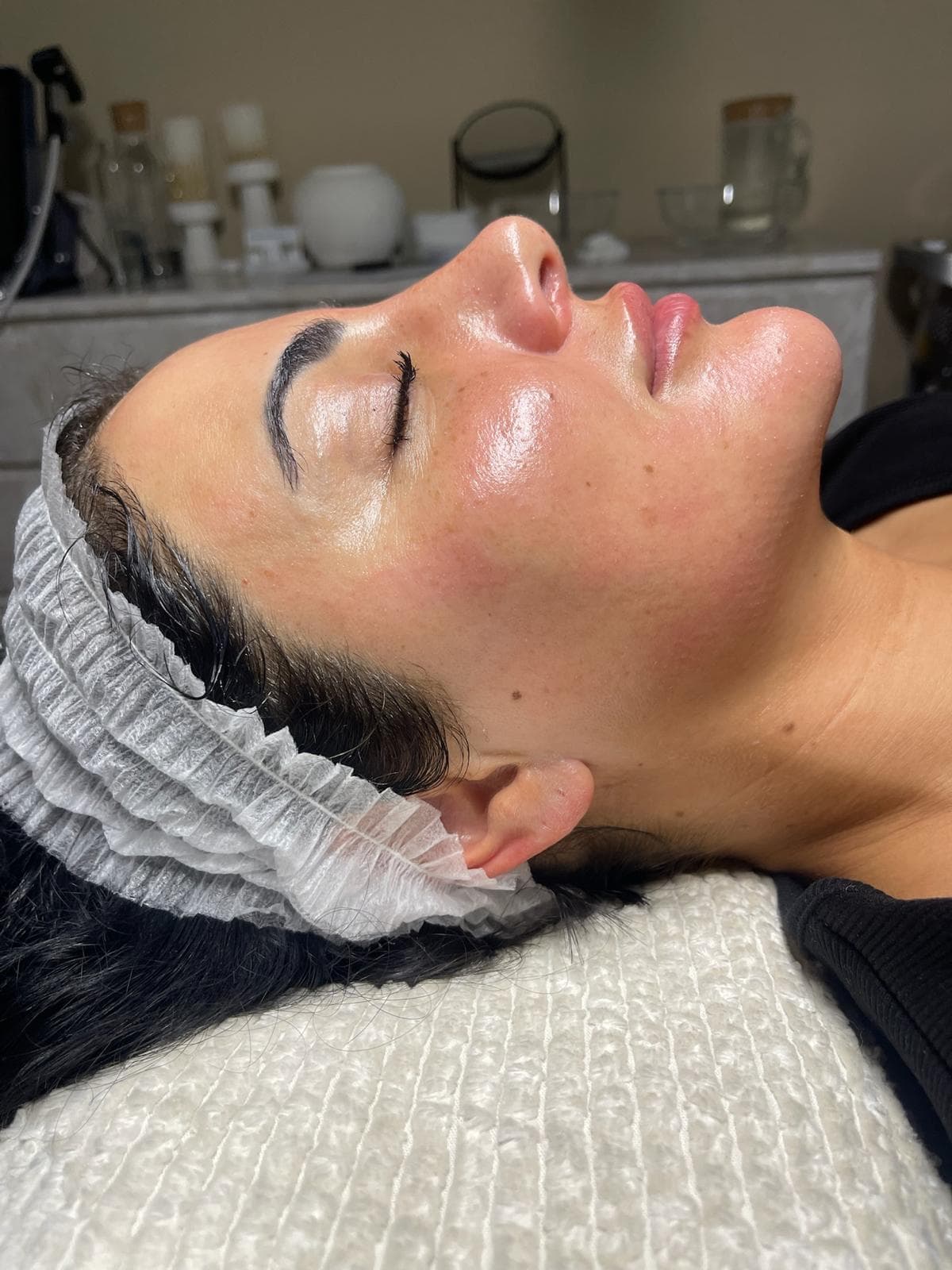 RF Crystal Microneedling 6