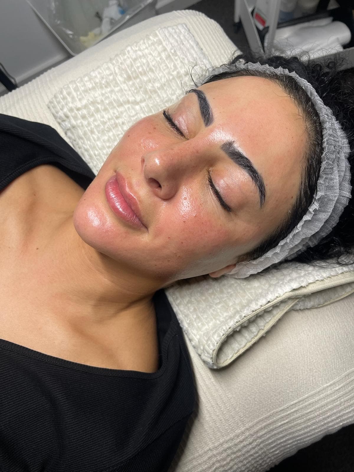 RF Crystal Microneedling 7