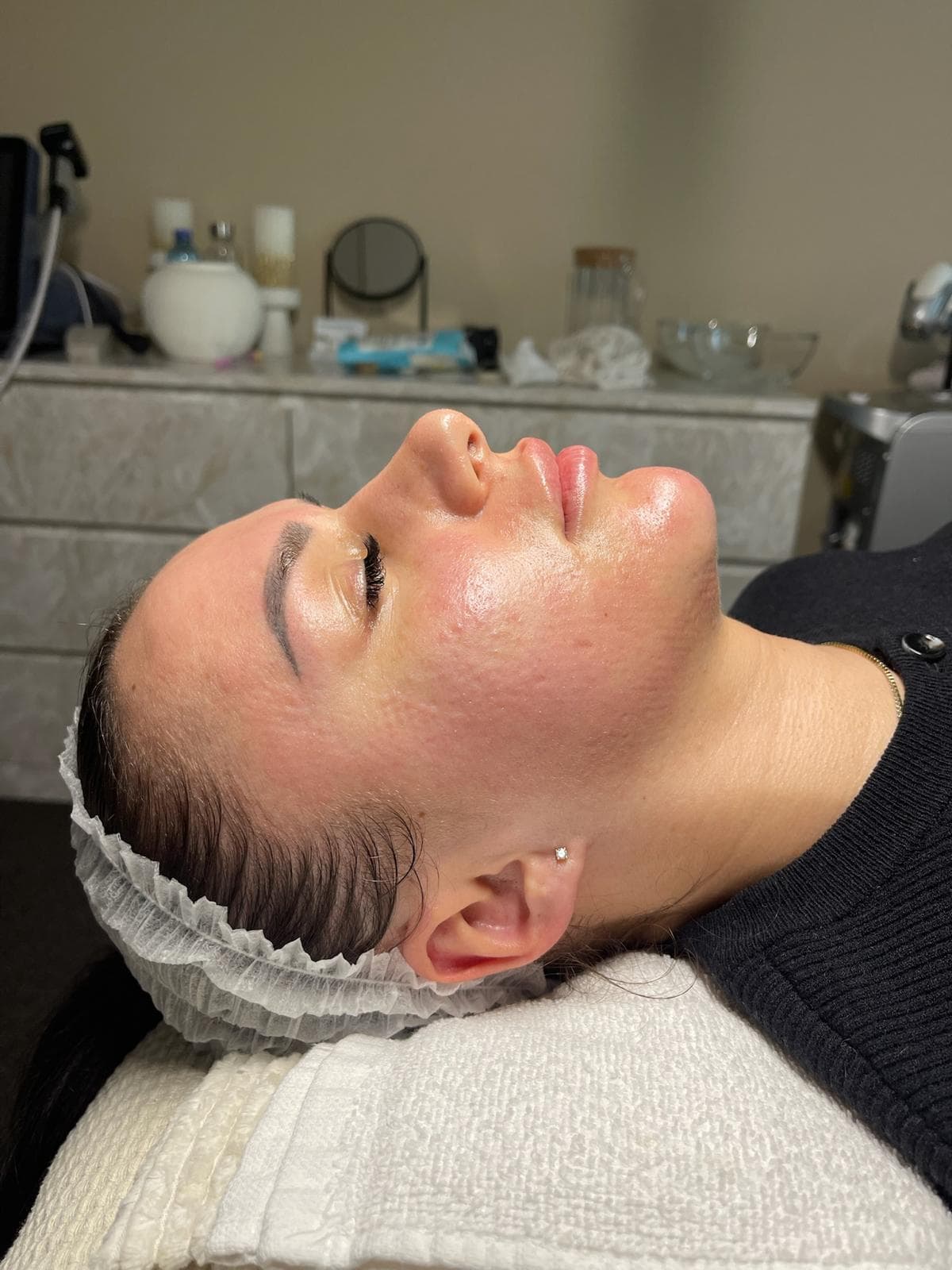 RF Crystal Microneedling 9