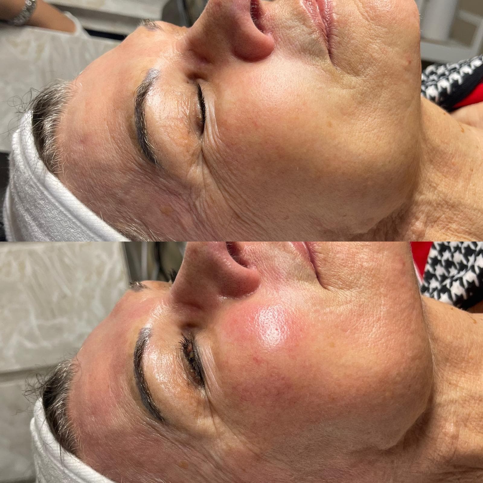 RF Crystal Microneedling 10