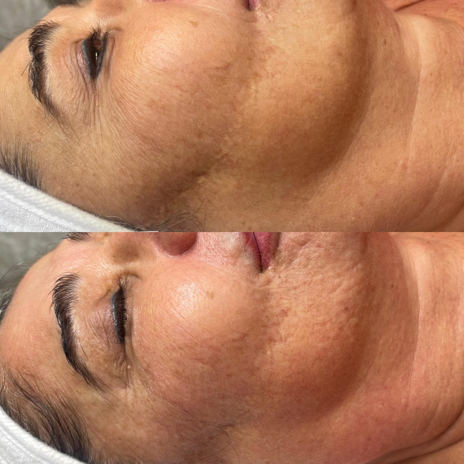 RF Crystal Microneedling 11